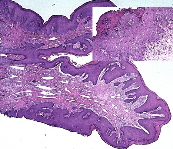 Кондилома под микроскопом