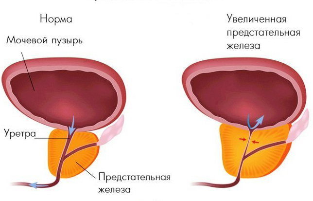 Увеличенная простатат и ее норма