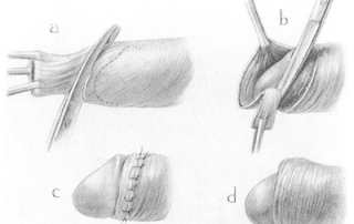 circumcision4x