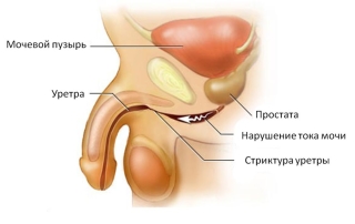 Стриктура уретры