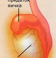 Воспаление яичка